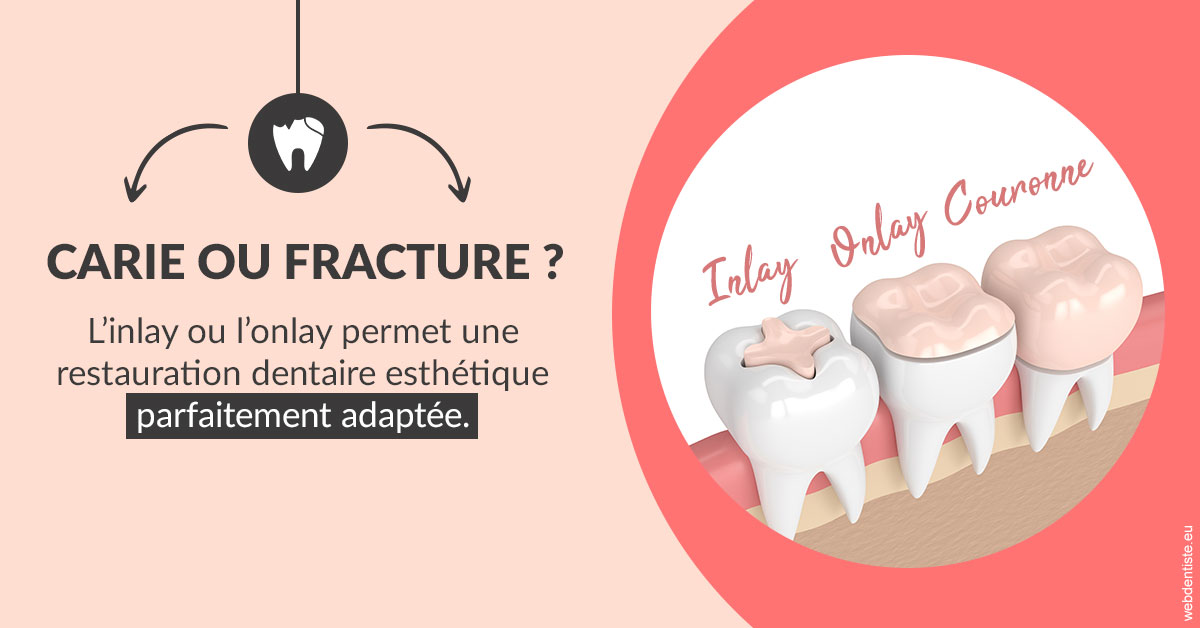 https://dr-marie-jose-huguenin.chirurgiens-dentistes.fr/T2 2023 - Carie ou fracture 2