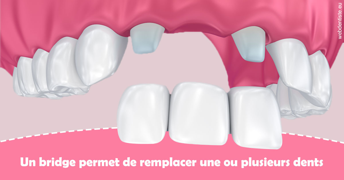 https://dr-marie-jose-huguenin.chirurgiens-dentistes.fr/Bridge remplacer dents 2