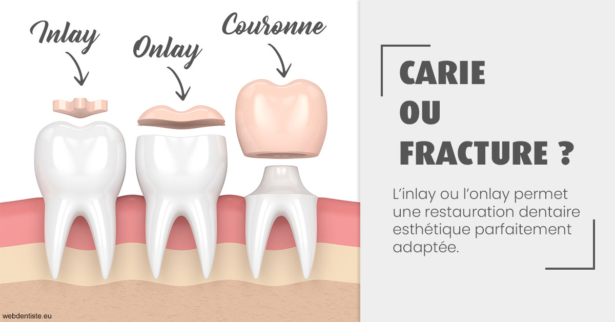 https://dr-marie-jose-huguenin.chirurgiens-dentistes.fr/T2 2023 - Carie ou fracture 1