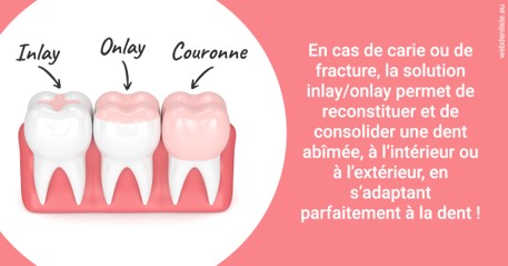 https://dr-marie-jose-huguenin.chirurgiens-dentistes.fr/L'INLAY ou l'ONLAY 2