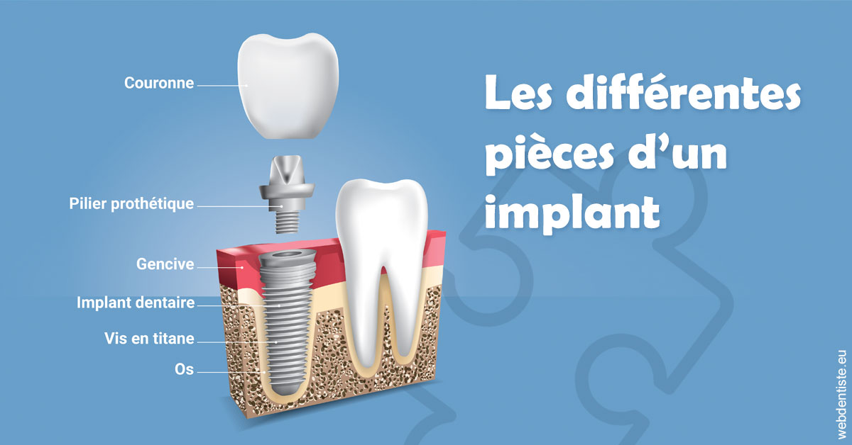 https://dr-marie-jose-huguenin.chirurgiens-dentistes.fr/Les différentes pièces d’un implant 1